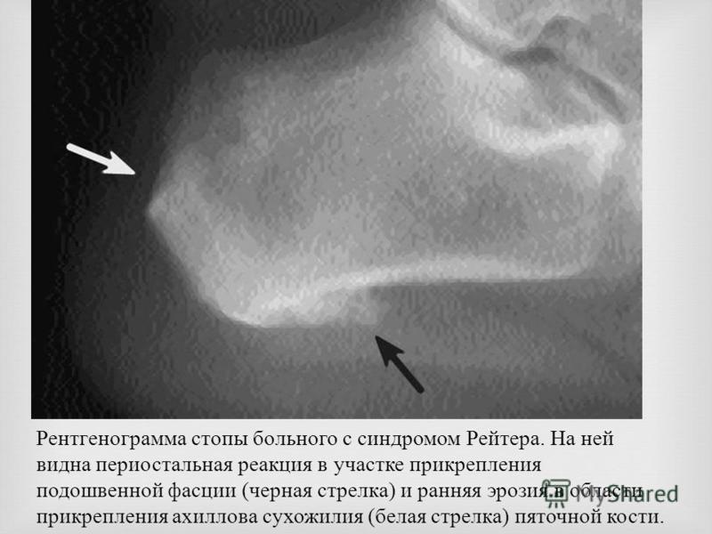 Рентгенограмма стопы больного с синдромом Рейтера. На ней видна периостальная реакция в участке прикрепления подошвенной фасции (черная стрелка) и ранняя эрозия в области прикрепления ахиллова сухожилия (белая стрелка) пяточной кости.