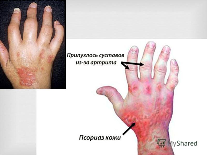 Операции на тазобедренном суставе - цены от 450000 руб. в Алматы Лечебные упражнения при поясничном остеохондрозе