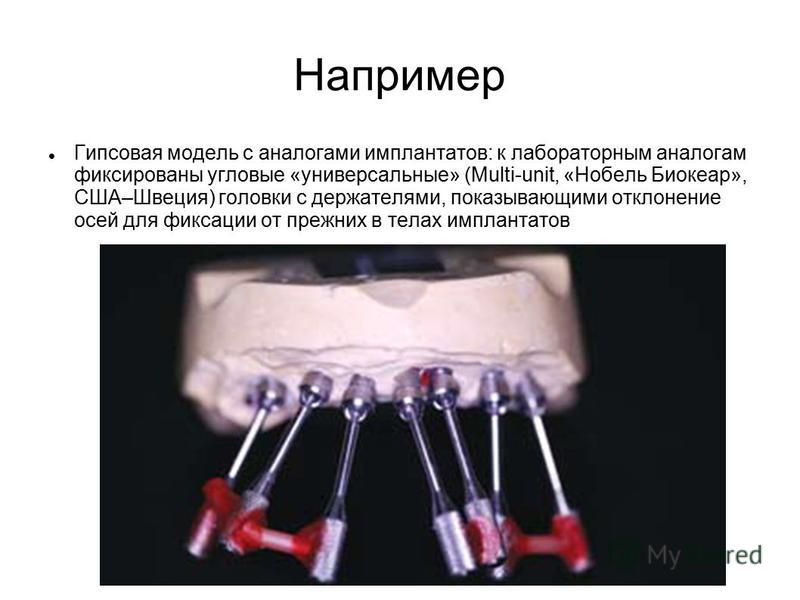 Например Гипсовая модель с аналогами имплантатов: к лабораторным аналогам фиксированы угловые «универсальные» (Multi-unit, «Нобель Биокеар», США–Швеция) головки с держателями, показывающими отклонение осей для фиксации от прежних в телах имплантатов