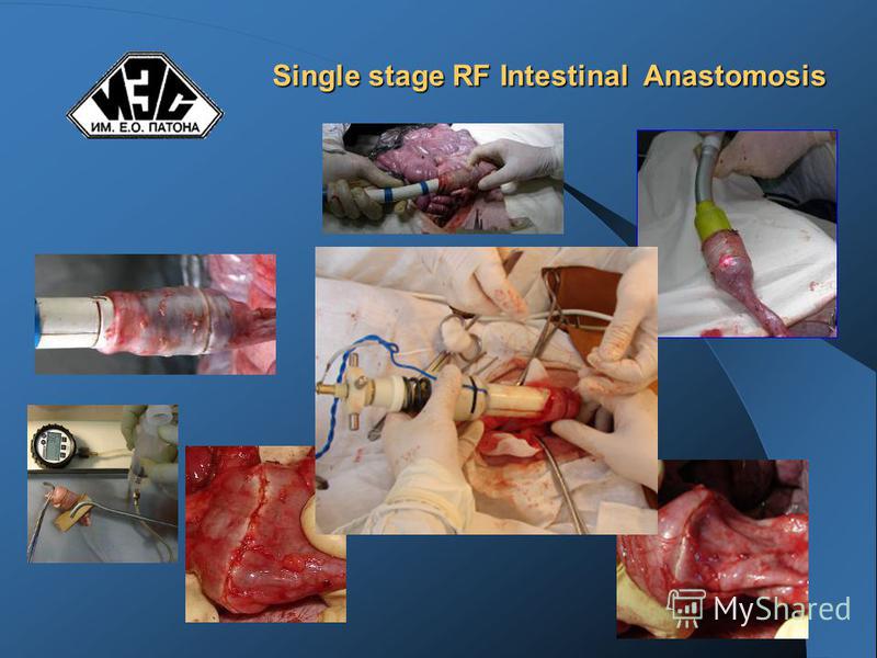 Single stage RF Intestinal Anastomosis