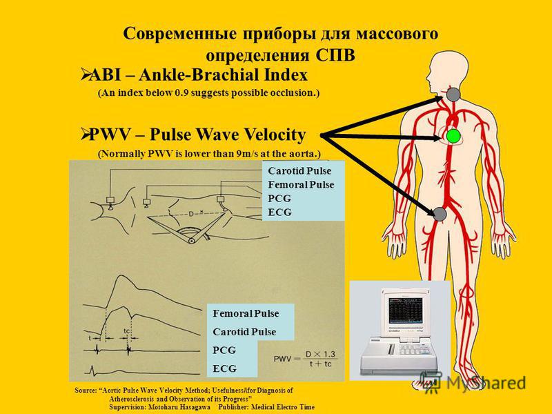 Современные приборы для массового определения СПВ ABI – Ankle-Brachial Index PWV – Pulse Wave Velocity (Normally PWV is lower than 9m/s at the aorta.) (An index below 0.9 suggests possible occlusion.) Femoral Pulse Carotid Pulse PCG ECG Source: Aorti