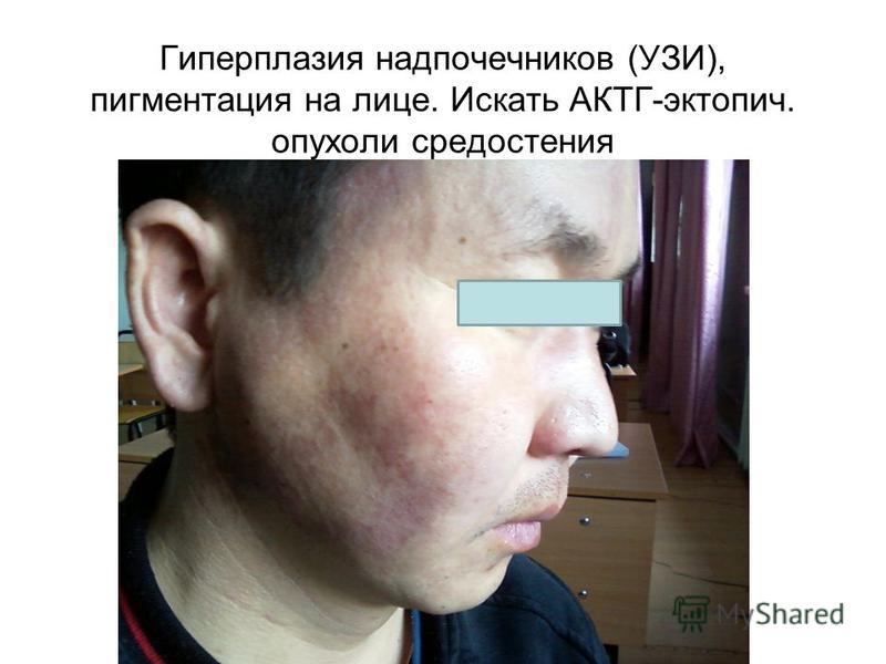 Гиперплазия надпочечников (УЗИ), пигментация на лице. Искать АКТГ-эктопия. опухоли средостения