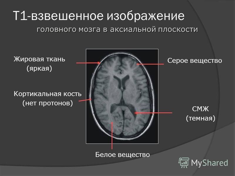 Т1 взвешенное изображение