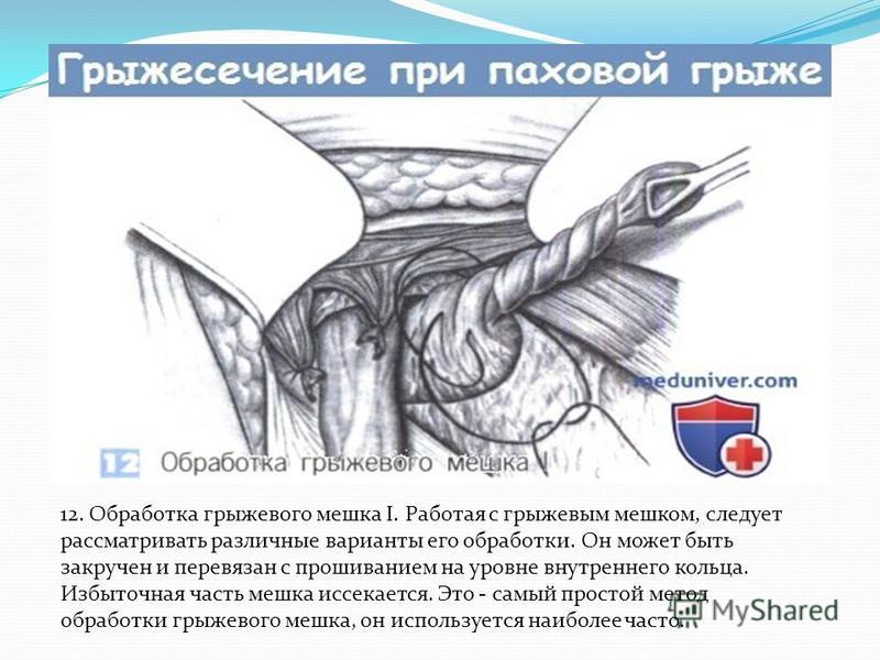 Как выглядит паховая грыжа у ребенка мальчика
