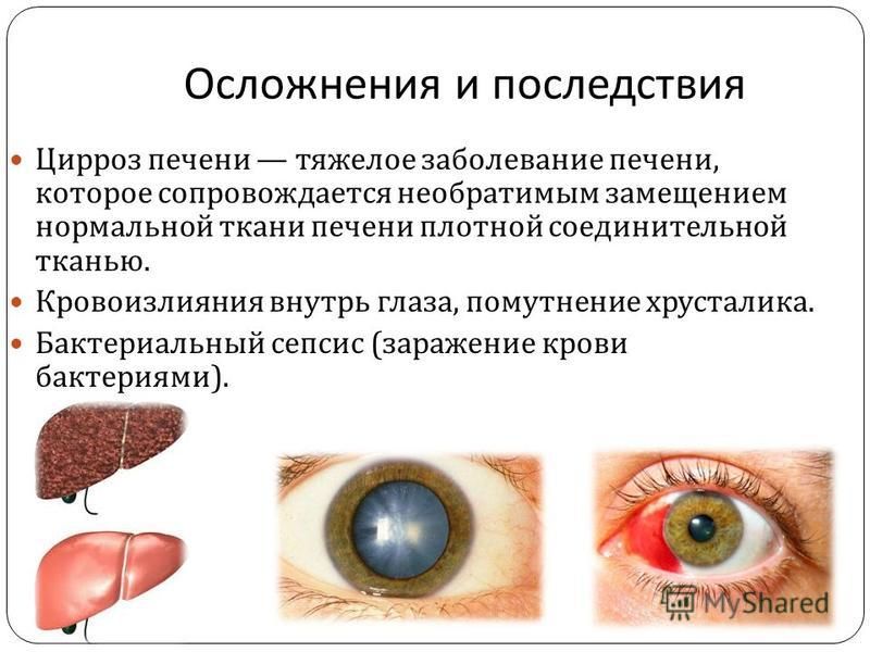Как выглядят глаза при циррозе печени Цирроз Печени Фото Глаз - New-Freepik.Ru