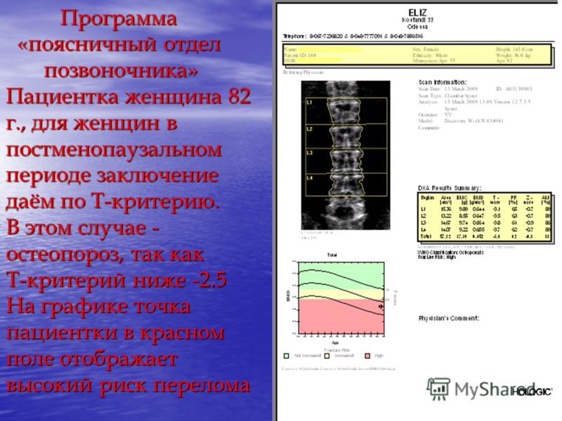остеопороз поясничного отдела позвоночника