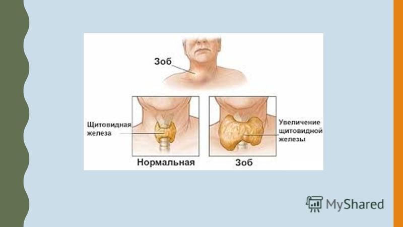 Презентация на тему диффузно токсический зоб