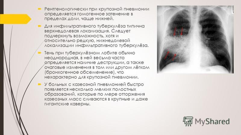 Туберкулез глотки презентация