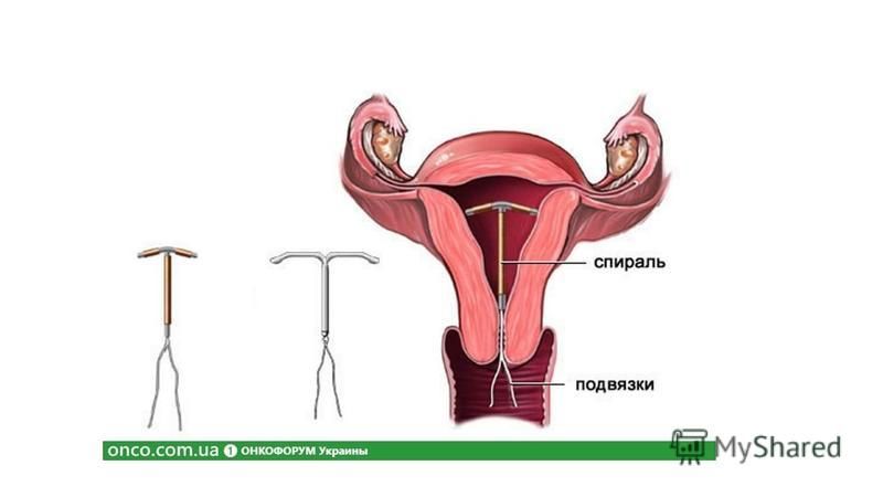 Спираль как выглядит внутри Могут ли выпадать волосы от спирали мирена - журнал 13malyshok.ru