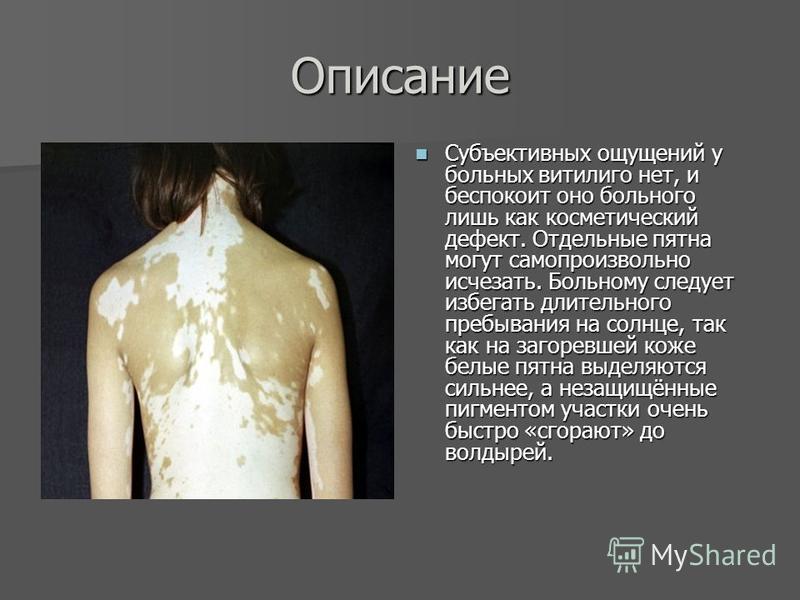 Что Такое Витилиго Фото Что Такое Витилиго Фото