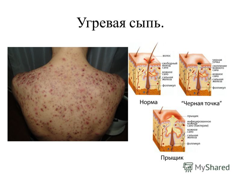 Темные бородавки на руках Темные бородавки на руках