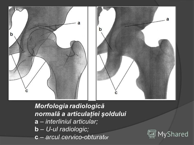 manifestarea unei boli a articulației șoldului dureri articulare și orizontale