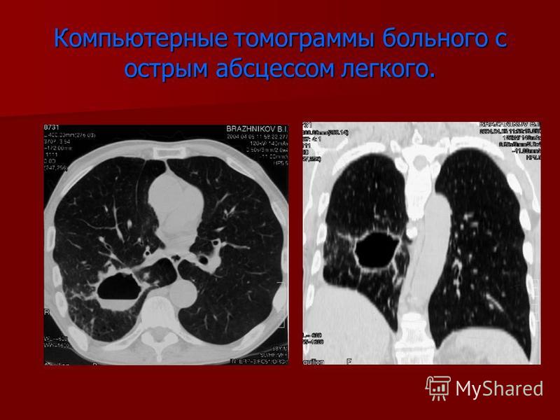 Абсцесс легкого кт картина