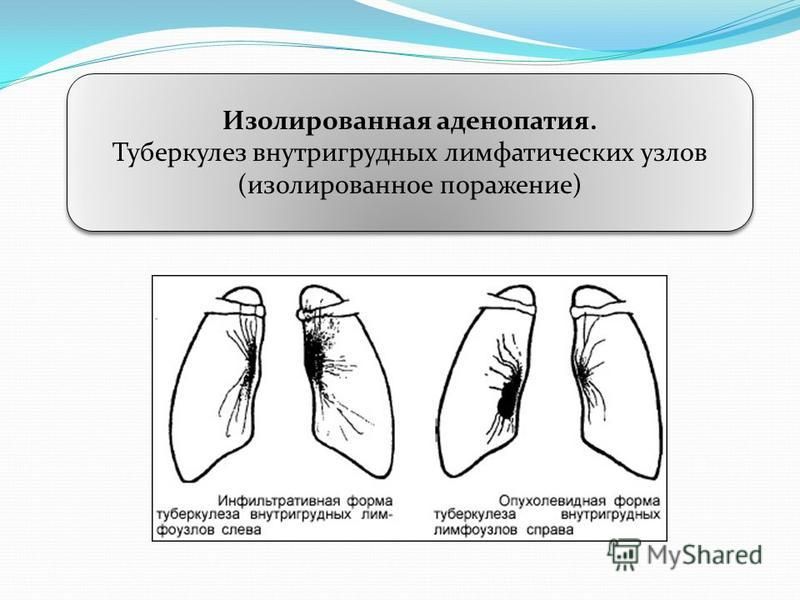 Туберкулез внутригрудных лимфатических узлов презентация