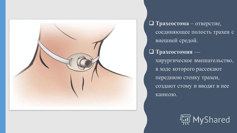 Как поменять трахеостому в домашних условиях