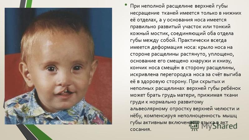 Расщелина Губы И Неба Фото - Mixyfotos.ru