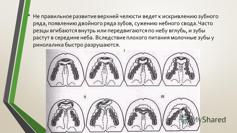 Файл:Cleft Nurser Mead Johnson.jpg - Википедия