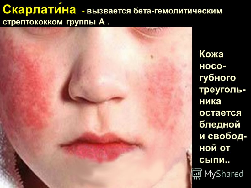 Болезни жкт с сыпью Болезни жкт с сыпью