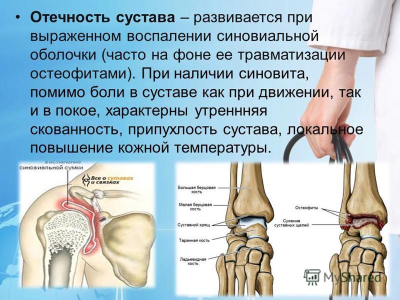 Припухлость сустава пальца руки. Боль в суставах кистей рук - причины появления, при каких заболеваниях. Кисть руки человека: анатомия и фото скелета, где находятся запястья и. Теносиновит де Кервена - KinesioPro