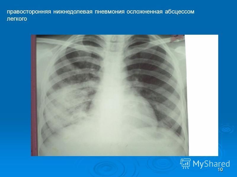 Реферат: Пневмония в правой нижней доле