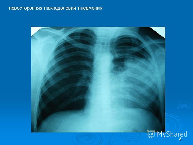 Реферат: Пневмония в правой нижней доле