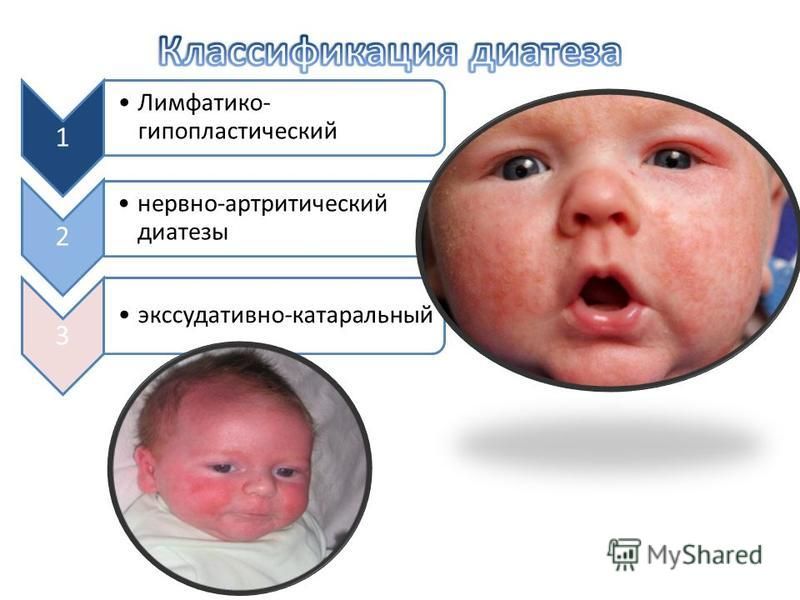 Диатез у детей на ногах как выглядит
