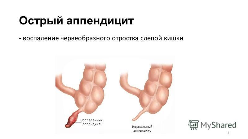 Острый аппендицит картинки для презентации