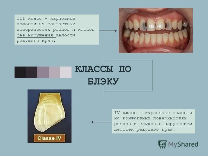 Классы по блэку в стоматологии в картинках