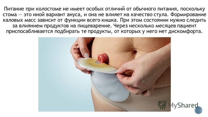 Колостома как выглядит на человеке Колостома локальный статус фото HobbiArt.ru
