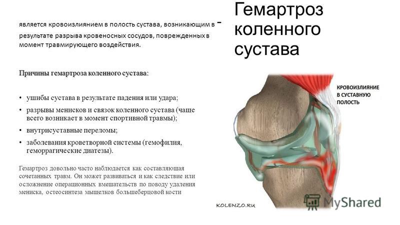 Гемартроз коленного сустава фото. Как снять опухоль и отек колена после ушиба: что делать и как лечить Гемартроз | Гемартроз коленного сустава лечение Гемартроз коленного сустава, симптомы, лечение | Суставам.ру