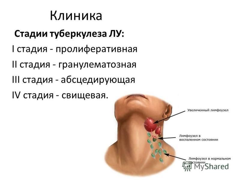 Презентация на тему фтизиатрия