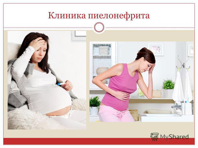 Проявление пиелонефрита у беременных 22