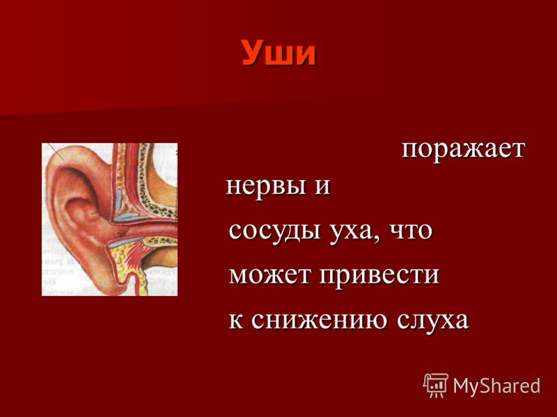 Уши поражает нервы и поражает нервы и сосуды уха, что сосуды уха, что может привести может привести к снижению слуха к снижению слуха