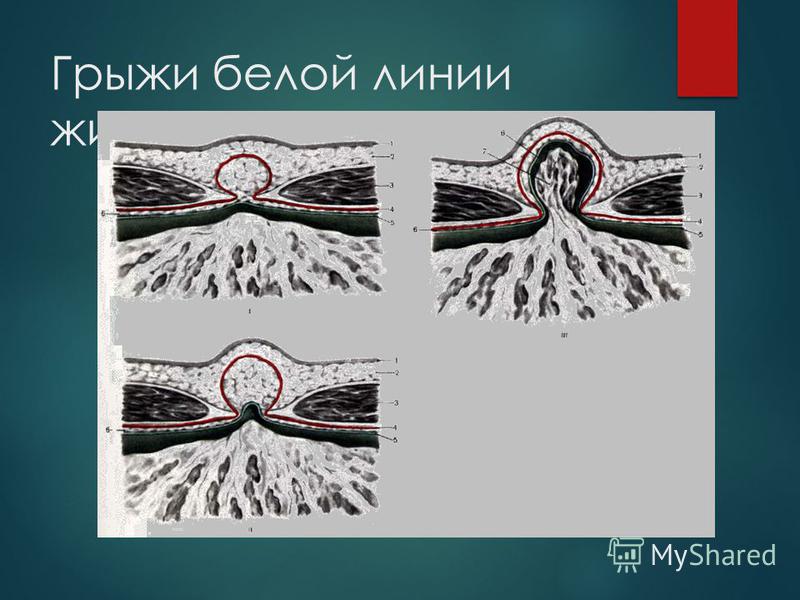 Диафрагмальная грыжа пластика по Диафрагмальная грыжа пластика по