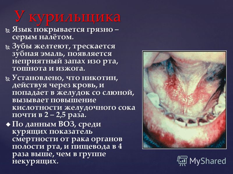 запах мокроты изо рта у ребенка запах мокроты изо рта у ребенка
