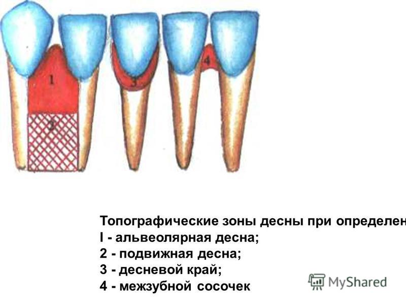 Межзубной сосочек на десне Межзубной сосочек на десне