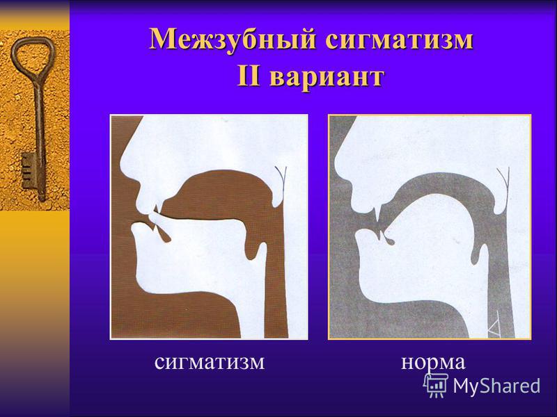 Межзубный сигматизм и его коррекция Межзубный сигматизм и его коррекция