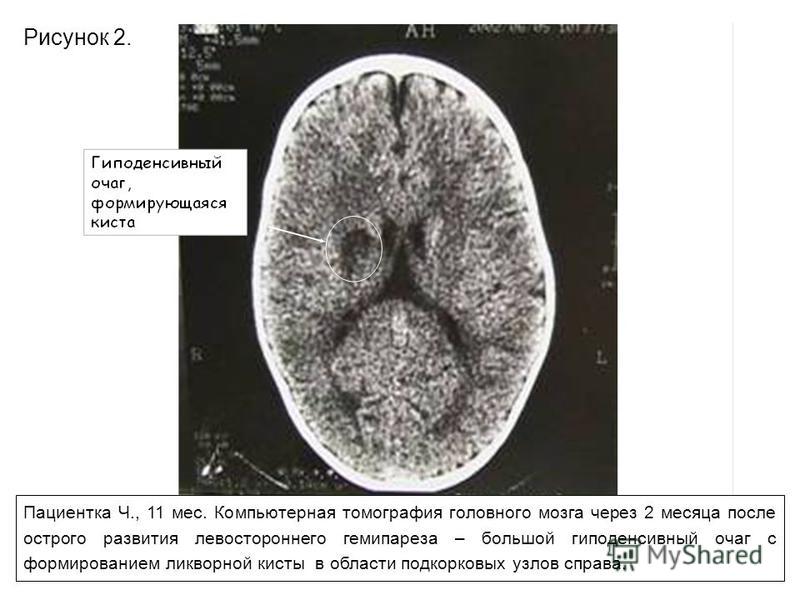 Пациентка Ч., 11 мес. Компьютерная томография головного мозга через 2 месяца после острого развития левостороннего гемипареза – большой гиподенсивный очаг с формированием ликворной кисты в области подкорковых узлов справа. Рисунок 2.