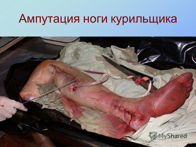 запах изо рта рак гортани запах изо рта рак гортани