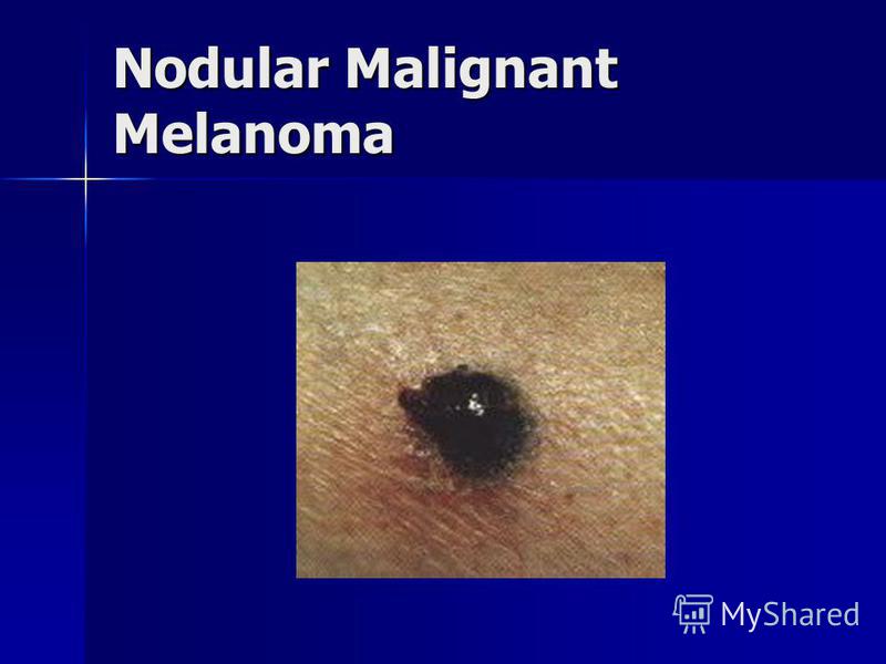 malignant melanoma essay This is the first page of cancernet’s guide to melanoma a cancerous tumor is malignant, meaning it can grow and spread to other parts of the body. malignant melanoma essay This is the first page of cancernet’s guide to melanoma a cancerous tumor is malignant, meaning it can grow and spread to other parts of the body.