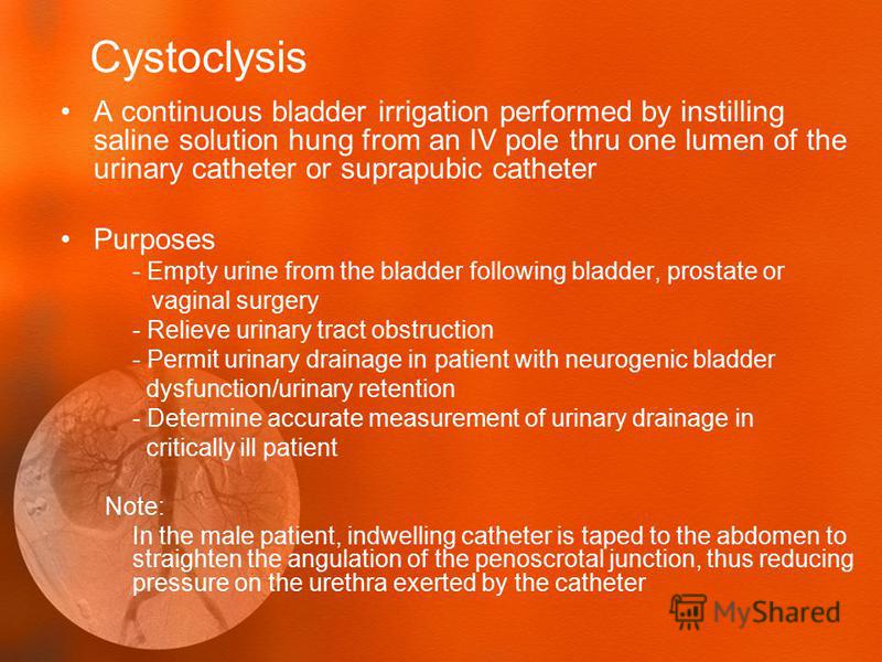 irrigating cystoclysis irrigating cystoclysis