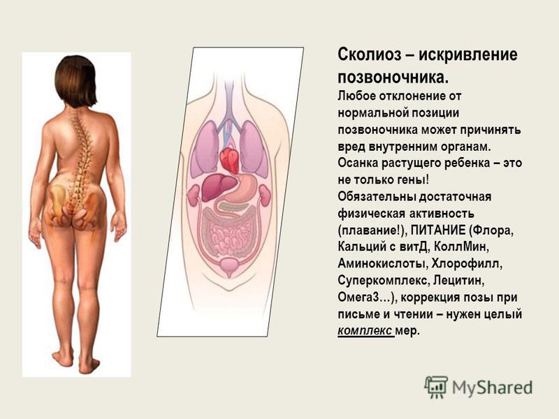 Комплекс остеохондроз сколиоз кифоз Комплекс остеохондроз сколиоз кифоз