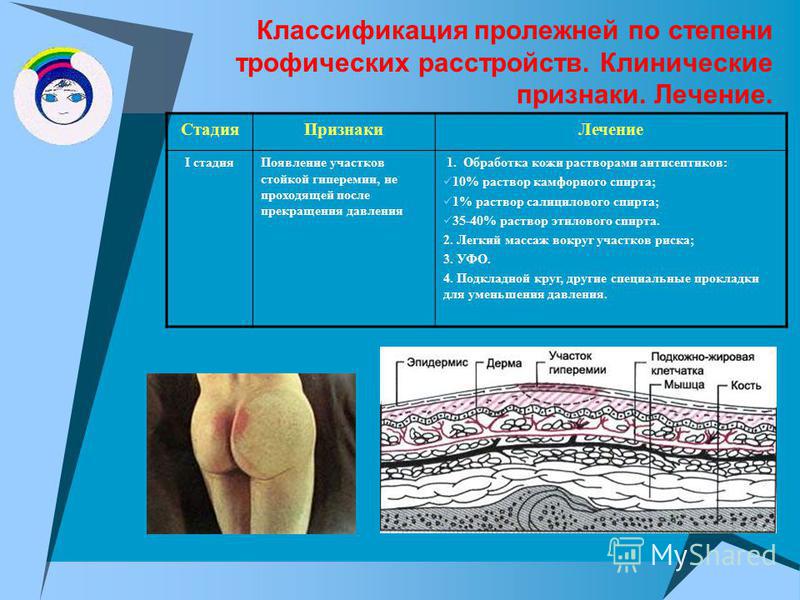Лечим пролежни в домашних условиях Лечим пролежни в домашних условиях