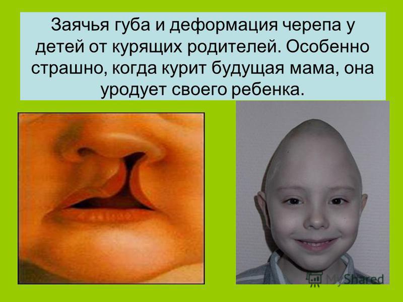 Заячья губа и деформация черепа у детей от курящих родителей. Особенно страшно, когда курит будущая мама, она уродует своего ребенка.