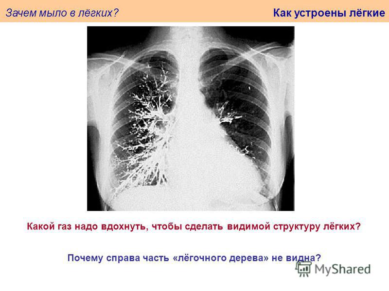 Зачем мыло в лёгких? Как устроены лёгкие Какой газ надо вдохнуть, чтобы сделать видимой структуру лёгких? Почему справа часть «лёгочного дерева» не видна?
