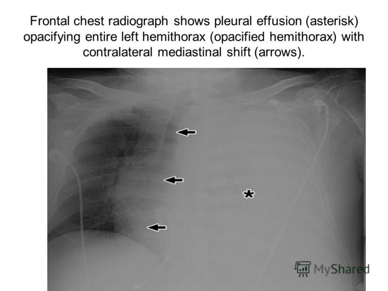 Frontal chest radiograph shows pleural effusion (asterisk) opacifying entire left hemithorax (opacified hemithorax) with contralateral mediastinal shift (arrows).