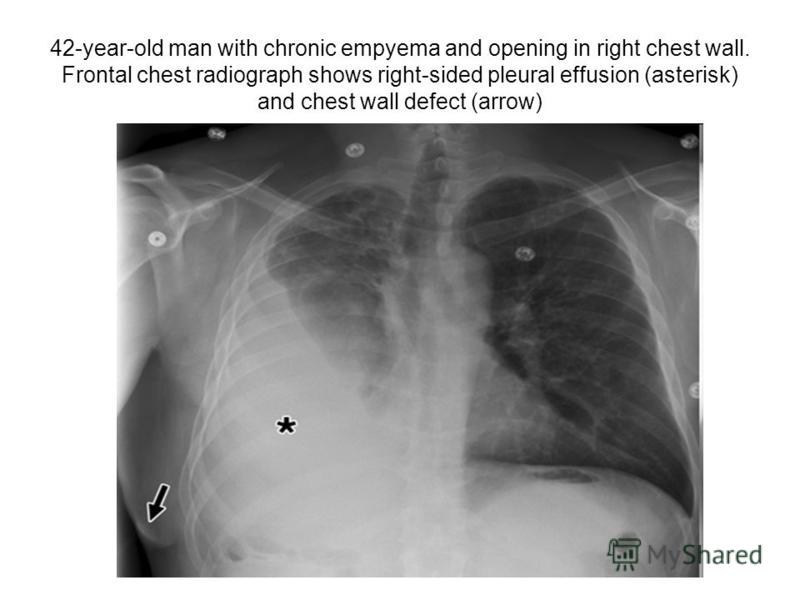42-year-old man with chronic empyema and opening in right chest wall. Frontal chest radiograph shows right-sided pleural effusion (asterisk) and chest wall defect (arrow)