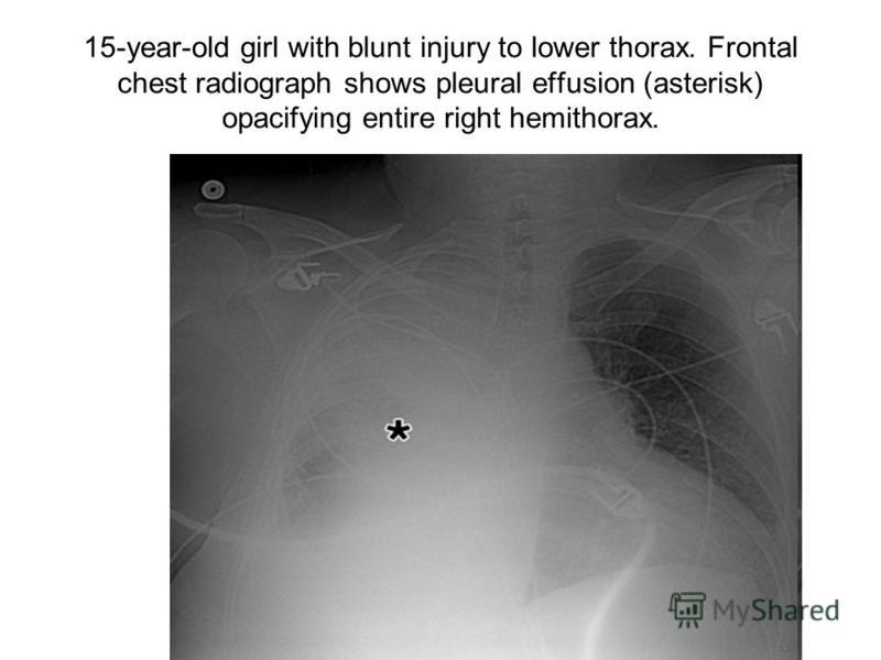 15-year-old girl with blunt injury to lower thorax. Frontal chest radiograph shows pleural effusion (asterisk) opacifying entire right hemithorax.