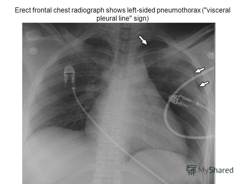 Erect frontal chest radiograph shows left-sided pneumothorax (visceral pleural line sign)