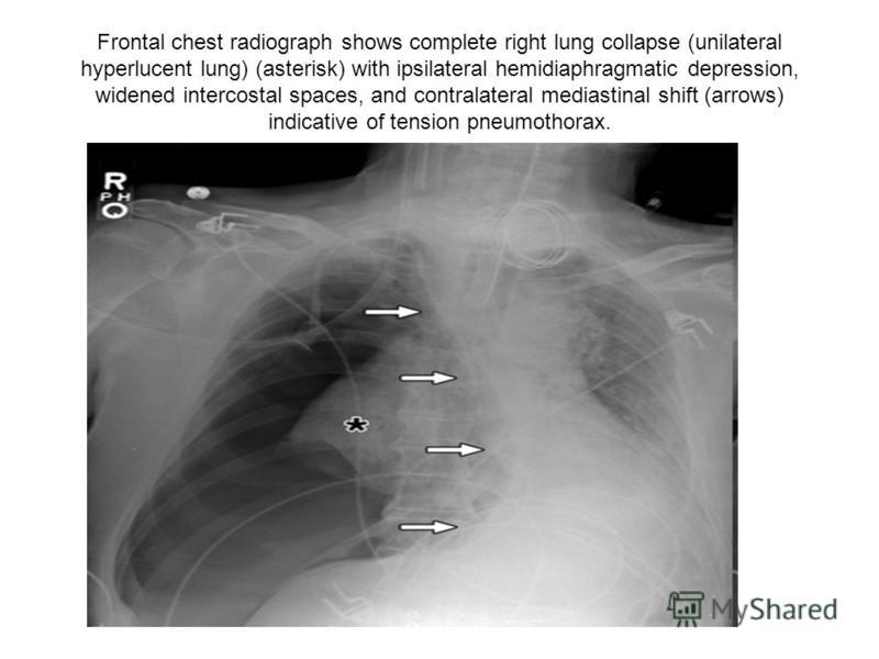 Frontal chest radiograph shows complete right lung collapse (unilateral hyperlucent lung) (asterisk) with ipsilateral hemidiaphragmatic depression, widened intercostal spaces, and contralateral mediastinal shift (arrows) indicative of tension pneumot